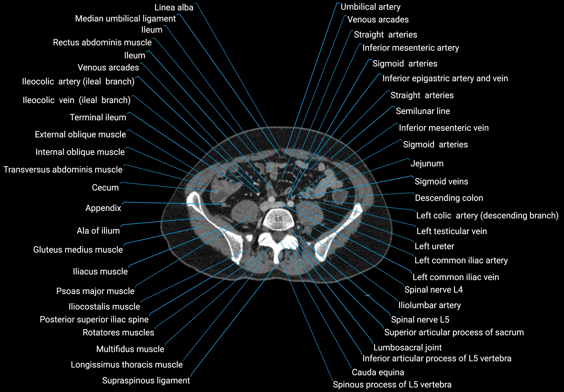 CT male pelvis axial cross sectional anatomy labelled radiology image -00128.webp